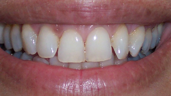 Veneers Before