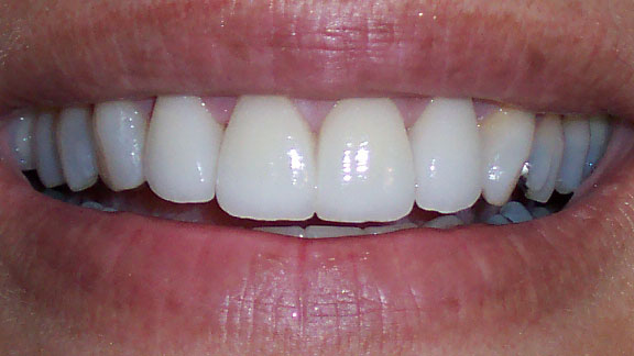 Veneers After