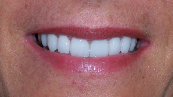 Veneers After