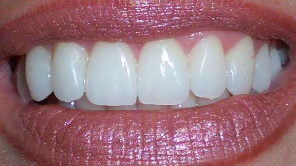 Veneers After